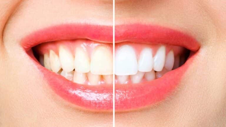 dents tartre