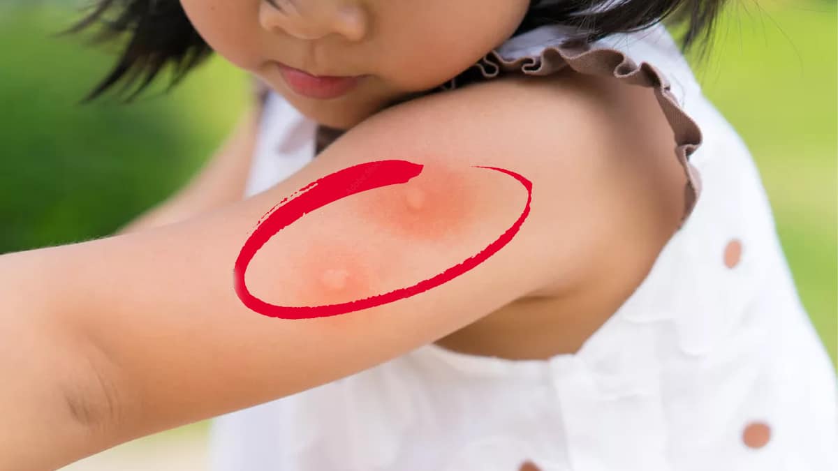 Piqûres de moustiques : cette dermatologue à trouvé comment les faire disparaître en quelques secondes